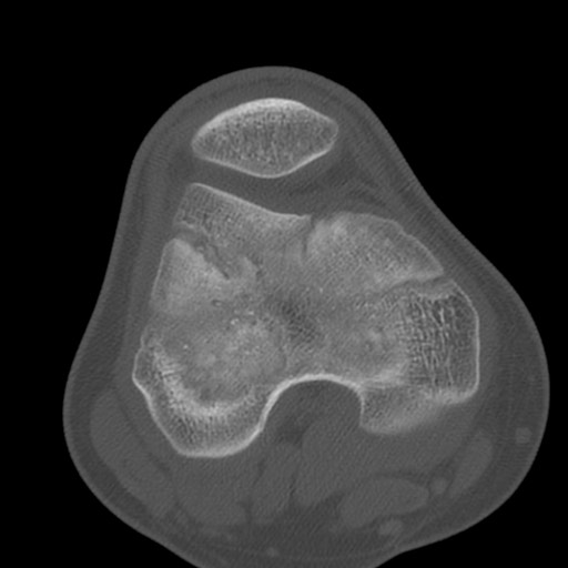 Brodie abscess of the tibia (Radiopaedia 58984-66250 Axial bone window 35).jpg