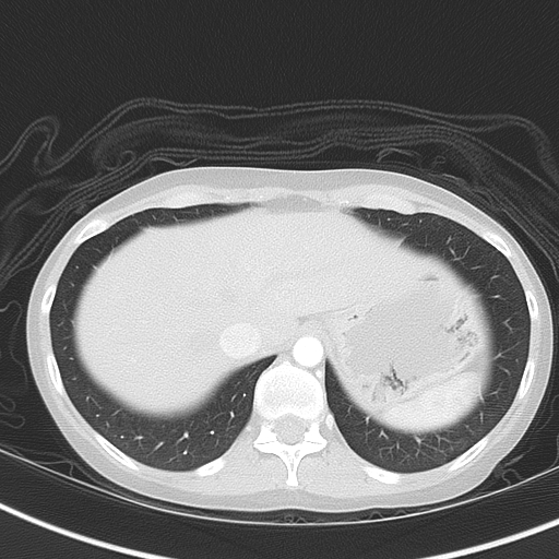 Bronchial atresia (Radiopaedia 73677-84470 Axial lung window 51).jpg