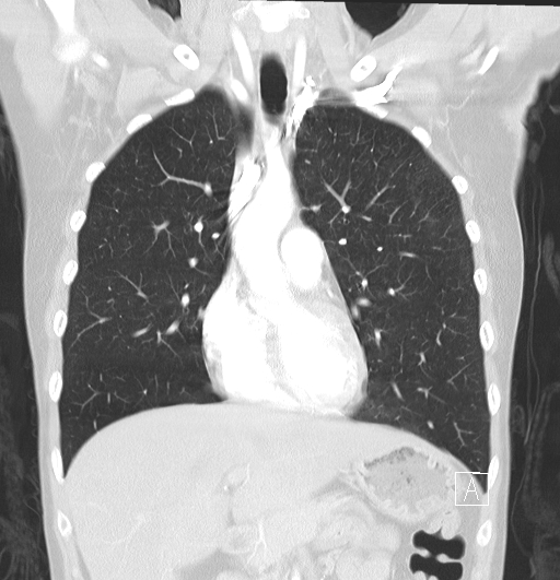 File:Bronchial atresia (Radiopaedia 73677-84470 Coronal lung window 12).jpg