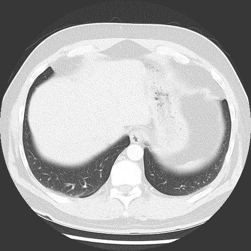 Bronchial carcinoid tumor (Radiopaedia 67377-76764 Axial lung window 51).jpg