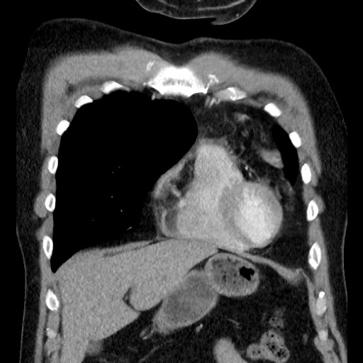 File:Bronchial carcinoid tumor (Radiopaedia 67377-76764 C 23).jpg