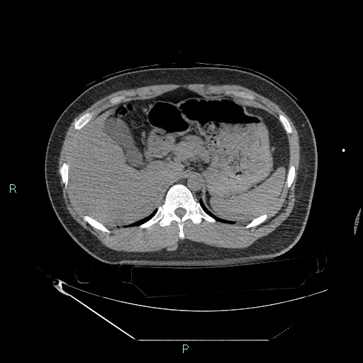 Bronchial carcinoid tumor (Radiopaedia 78272-90870 Axial non-contrast 106).jpg