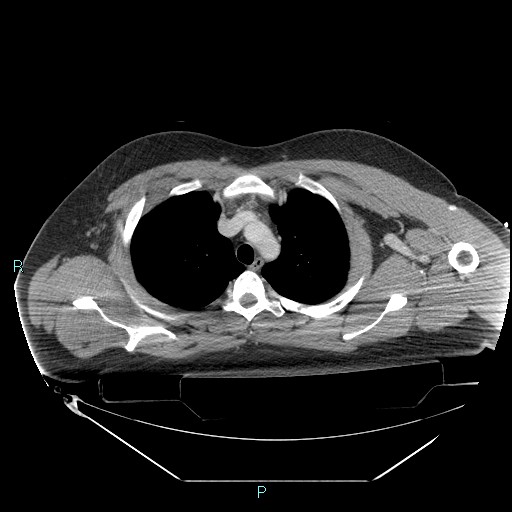 Bronchial carcinoid tumor (Radiopaedia 78272-90870 C 34).jpg