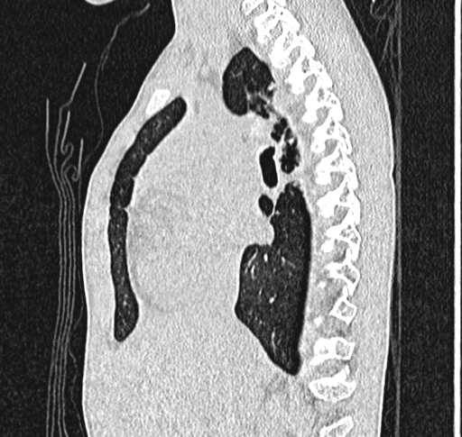 Bronchiolitis obliterans (Radiopaedia 71538-81897 Sagittal lung window 28).jpg