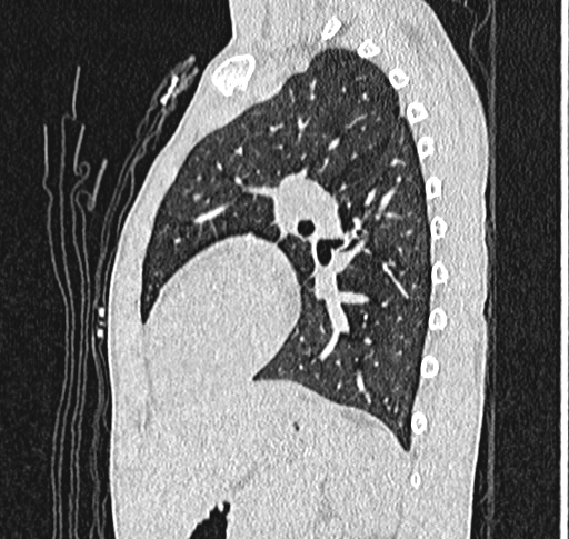 Bronchiolitis obliterans (Radiopaedia 71538-81897 Sagittal lung window 45).jpg
