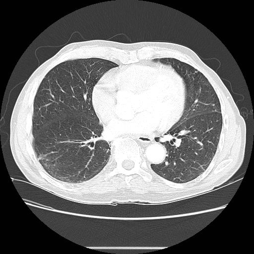 File:Bronchocele (Radiopaedia 17097-16795 Axial lung window 75).jpg