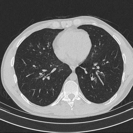 Bronchocele (Radiopaedia 60676-68429 Axial lung window 47).jpg