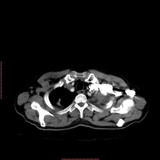 File:Bronchogenic carcinoma with left atrial large deposit - T4N3M1a (Radiopaedia 42316-45428 A 6).jpg
