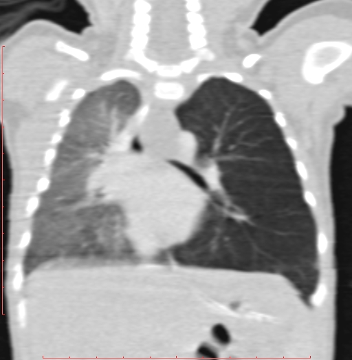 File:Bronchogenic cyst (Radiopaedia 78599-91409 Coronal lung window 130).jpg