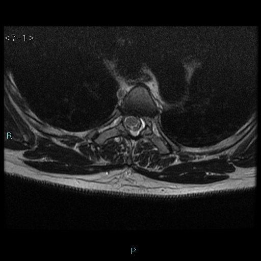 File:Bronchogenic cyst - posterior mediastinal (Radiopaedia 43885-47365 Axial T2 1).jpg