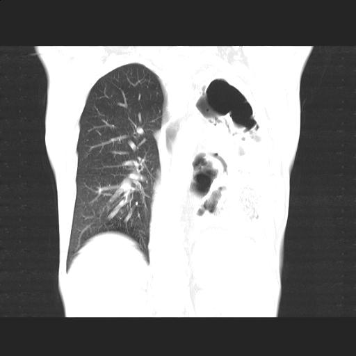 File:Bronchopleural fistula secondary to tuberculosis (Radiopaedia 20415-20322 Coronal lung window 15).jpg