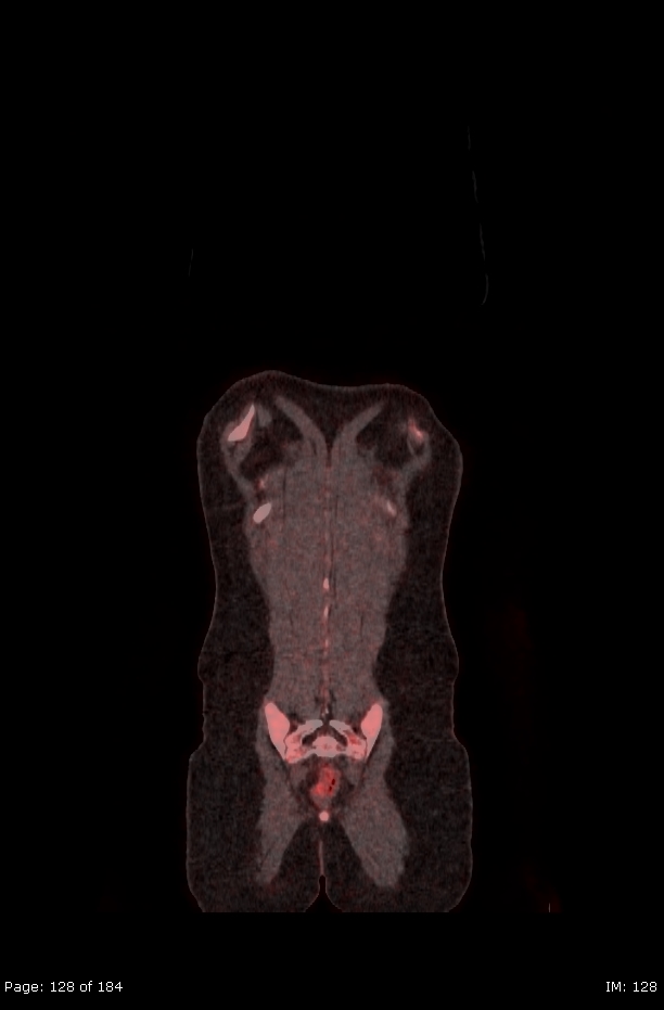 Brown fat uptake (FDG PET-CT) (Radiopaedia 77392-89513 Fused coronal 86).jpg