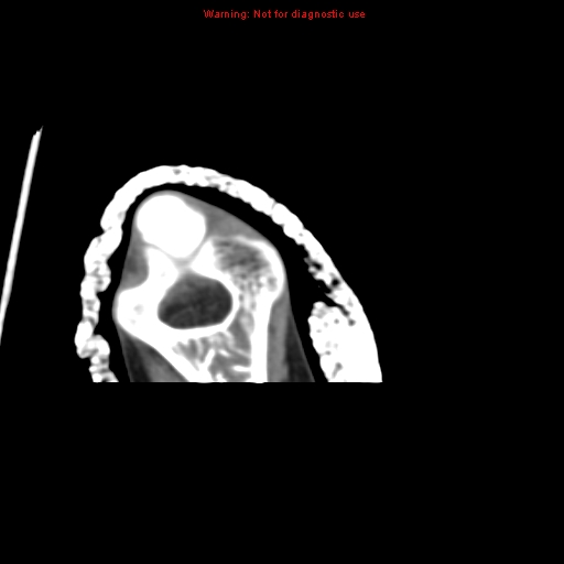 Brown tumor (Radiopaedia 12460-12694 Axial non-contrast 141).jpg