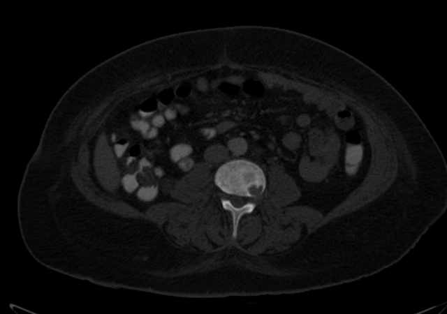 Brown tumors compressing the spinal cord (Radiopaedia 68442-77988 G 69).jpg