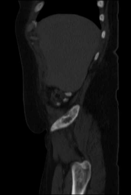 Brown tumors compressing the spinal cord (Radiopaedia 68442-77988 H 10).jpg