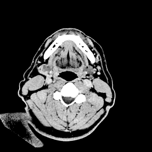 Buccal fat pad arteriovenous malformation (Radiopaedia 70936-81142 Axial non-contrast 5).jpg