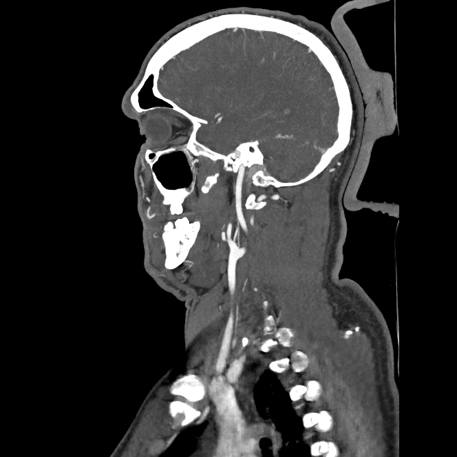 Buccal fat pad arteriovenous malformation (Radiopaedia 70936-81144 C 56).jpg