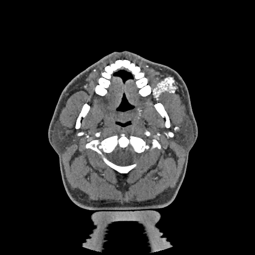 Buccal fat pad arteriovenous malformation (Radiopaedia 70936-81144 D 202).jpg
