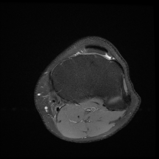 File:Bucket-handle meniscus tear (Radiopaedia 65700-74809 Axial PD fat sat 22).jpg