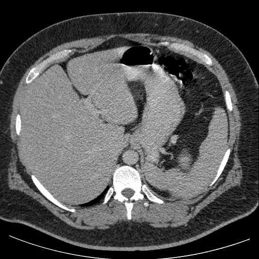 File:Burned-out testicular seminoma - retroperitoneal nodal metastases (Radiopaedia 62872-71245 A 15).jpg