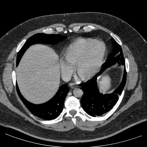 Burned-out testicular seminoma - retroperitoneal nodal metastases (Radiopaedia 62872-71245 A 7).jpg