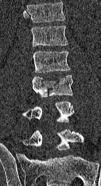 Burst fracture (Radiopaedia 53373-59357 Coronal bone window 40).jpg