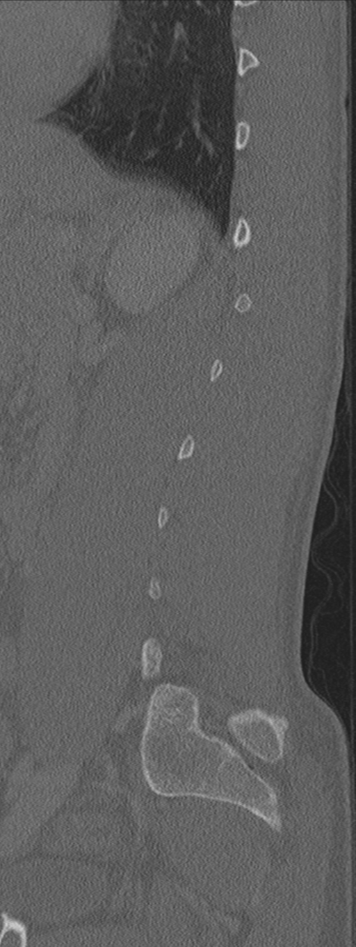 Burst fracture - T12 with conus compression (Radiopaedia 56825-63647 Sagittal bone window 19).png