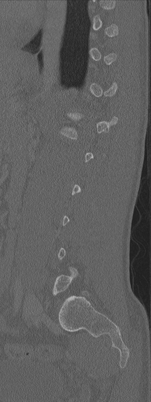 Burst fracture - T12 with conus compression (Radiopaedia 56825-63647 Sagittal bone window 25).png