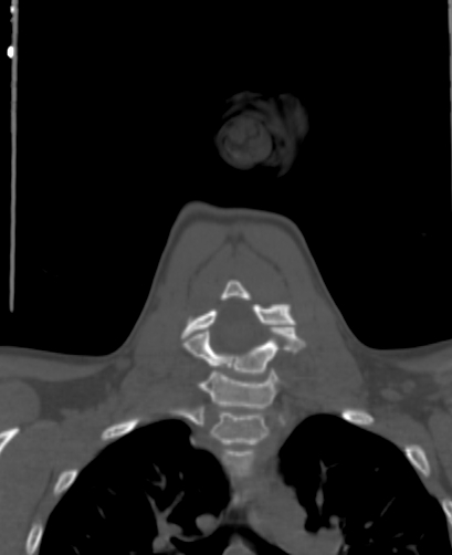 File:Butterfly vertebra (Radiopaedia 77903-90209 Coronal bone window 43).jpg