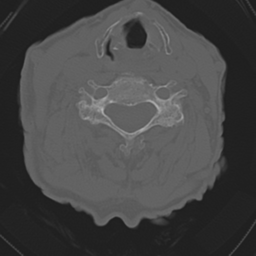 File:C2 fracture with vertebral artery dissection (Radiopaedia 37378-39199 Axial bone window 31).png