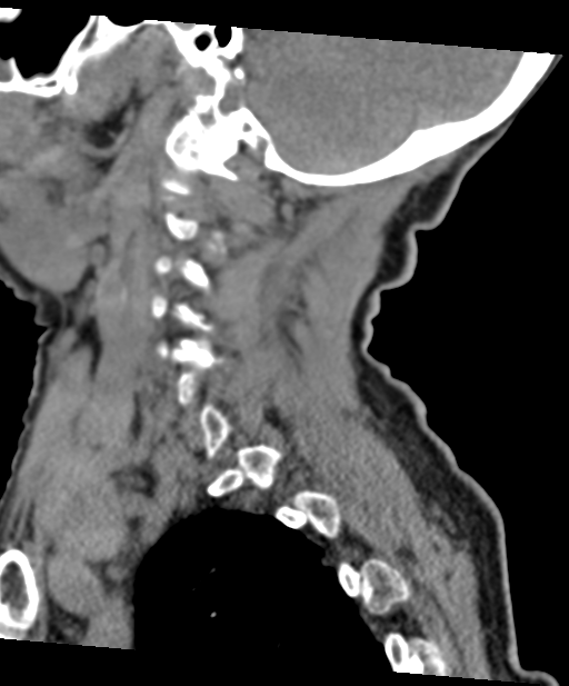 C2 fracture with vertebral artery dissection (Radiopaedia 37378-39199 D 57).png