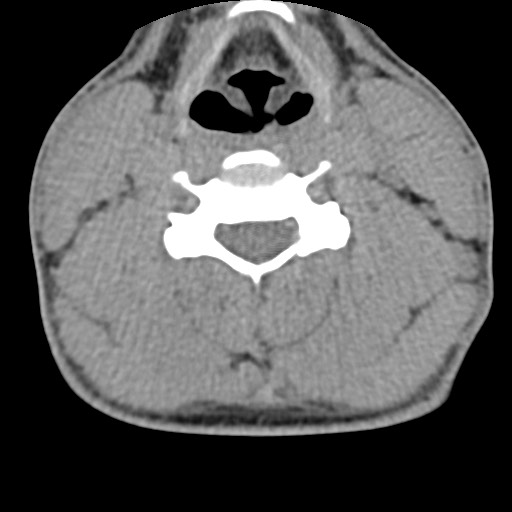 File:C5 facet fracture (Radiopaedia 58374-65499 Axial non-contrast 51).jpg