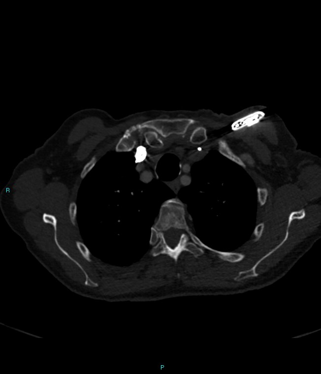 Calcified cerebral emboli from left ventricular thrombus (Radiopaedia 84420-99760 Axial bone window 14).jpg