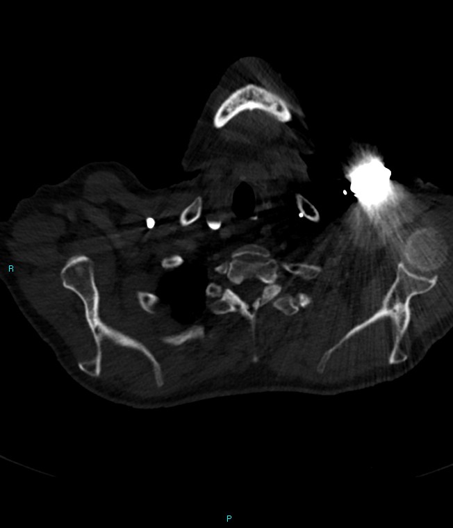 Calcified cerebral emboli from left ventricular thrombus (Radiopaedia 84420-99760 Axial bone window 4).jpg