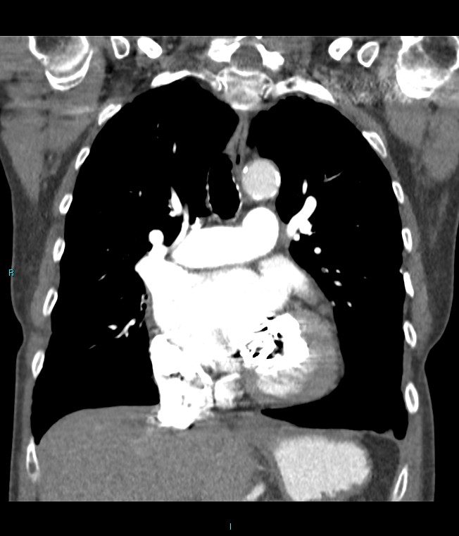 Calcified cerebral emboli from left ventricular thrombus (Radiopaedia 84420-99760 Coronal C+ CTPA 43).jpg