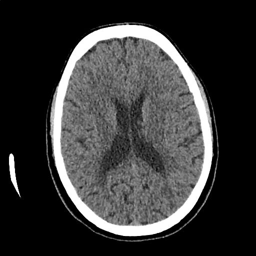 Calcified cerebral hydatid cyst (Radiopaedia 65603-74717 Axial non-contrast 44).jpg