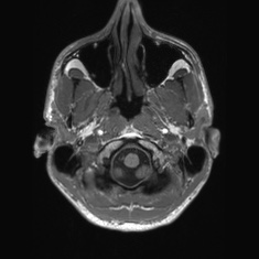 Callosal dysgenesis with interhemispheric cyst (Radiopaedia 53355-59335 Axial T1 13).jpg