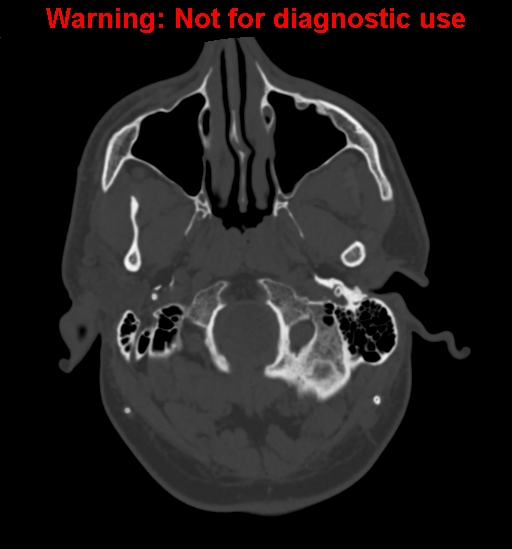Calvarial thickening from chronic shunting (Radiopaedia 60079-67637 Axial bone window 13).jpg