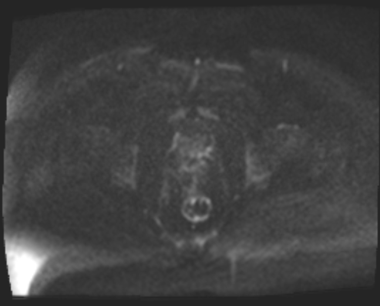 Cancer cervix - stage IIb (Radiopaedia 75411-86615 Axial DWI 64).jpg