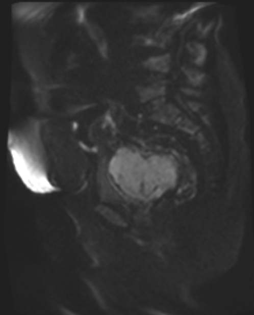 Cancer cervix - stage IIb (Radiopaedia 75411-86615 Sagittal DWI 61).jpg