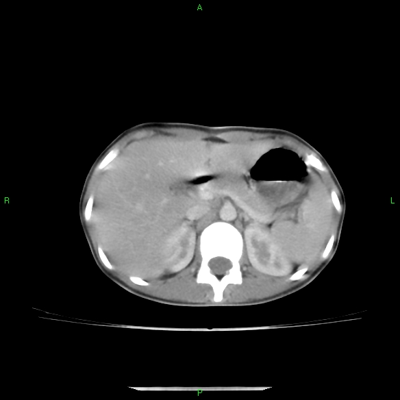 File:Cannon ball metastases - synovial sarcoma (Radiopaedia 26135-26271 C 38).jpg