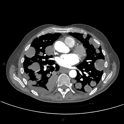 Cannonball metastases (Radiopaedia 82110-96150 Axial C+ CTPA 187).jpg