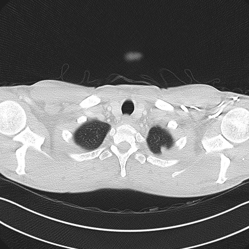 Cannonball metastases - testicular choriocarcinoma (Radiopaedia 84510-99891 Axial lung window 11).jpg