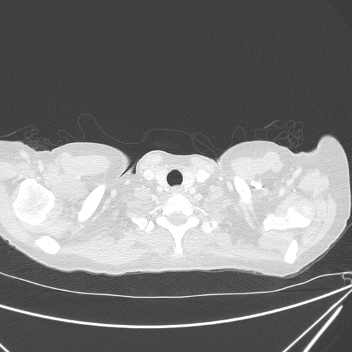 File:Canonball lung metastasis (Radiopaedia 77634-89837 Axial lung window 5).jpg