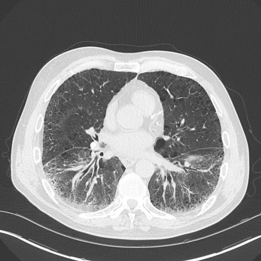 Caplan syndrome (Radiopaedia 56667-63530 Axial lung window 117).jpg