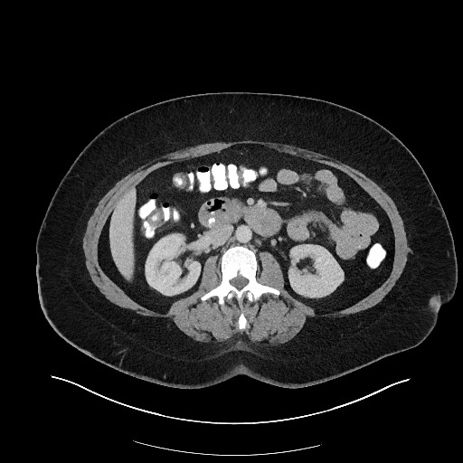 Carcinoid tumor - terminal ileum (Radiopaedia 60931-68739 A 60).jpg