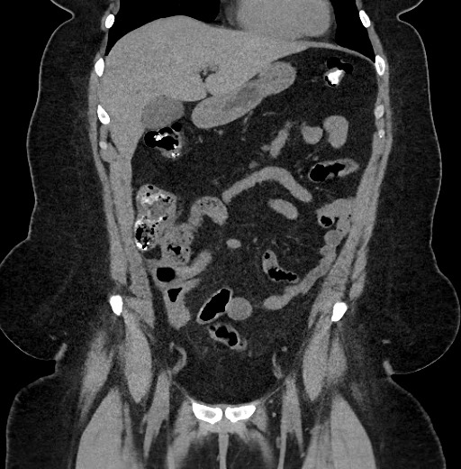 Carcinoid tumor - terminal ileum (Radiopaedia 60931-68740 Coronal non-contrast 29).jpg