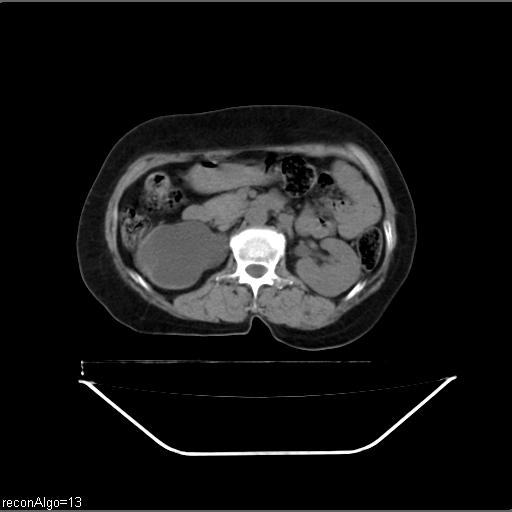 File:Carcinoma cervix- recurrence (Radiopaedia 34702-36137 Axial non-contrast 20).jpg