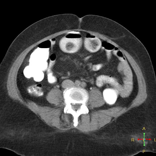 File:Carcinoma of sigmoid colon (Radiopaedia 23071-23100 C+ delayed 14).jpg