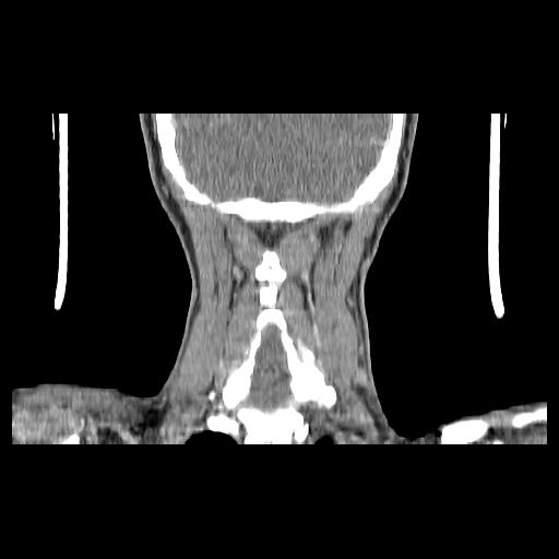 Carcinoma of the maxillary antrum (Radiopaedia 53805-59888 Coronal C+ delayed 136).jpg
